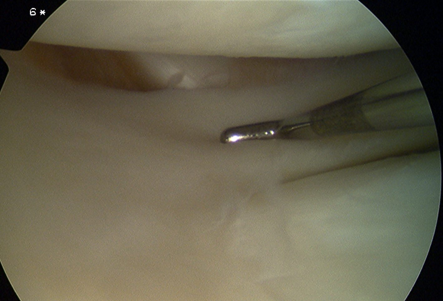 Knee Arthroscopy Popliteus